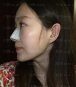 深圳阳光整形美容医院肋软骨隆鼻介绍片较新分享——现在感觉恢复的还不错，只要不太用力去摸鼻子，已经感觉不到疼了