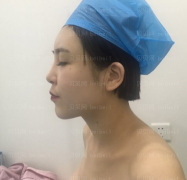 深圳阳光整形美容医院复合隆胸介绍片较新分享——现在恢复的已经很不错了