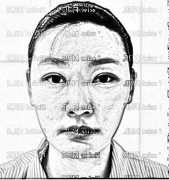 深圳仁安雅医疗美容医院李政权,假体隆鼻介绍,尽早见到彻底恢复好的模样
