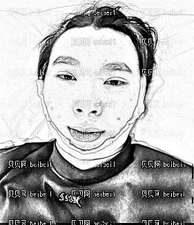 深圳千羽医疗美容整形医院王明辉,颧骨内推整形介绍,体会自已确实有长帅哦