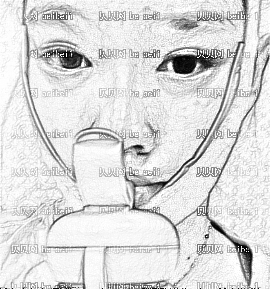 深圳千羽医疗美容整形医院王明辉,下颚角整形,只是整体化好许多了