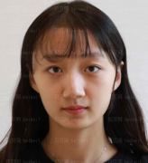 深圳阳光整形美容医院罗志敏假体隆鼻+耳软骨垫鼻尖介绍片较新分享——拆线以后鼻子就迅速的消肿，鼻型也越来越自然，越来越好看了