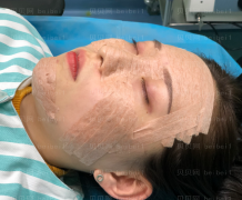 深圳阳光整形美容医院任义自体脂肪填充面部介绍片较新分享——脸慢慢的变得越来越自然了
