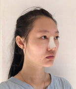 深圳阳光整形美容医院任义硅胶隆鼻介绍片较新分享——做完鼻子到现在有半年了，看起来很自然哦