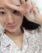 深圳阳光整形美容医院任义肋软骨隆鼻介绍片较新分享——做完隆鼻手术正好百天了，已经恢复的很好了