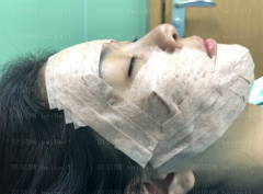 深圳阳光整形美容医院万晓楠自体脂肪填充面部介绍片较新分享——感觉我的脸色好了很多，皮肤也白了，减龄了很多哦
