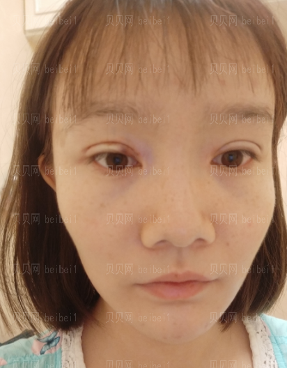深圳阳光整形美容医院邹进进双眼皮+开眼角介绍片较新分享——自从有了双眼皮之后,随随便便撸个妆都感觉自己美爆了,现在的我比以前可自信多了