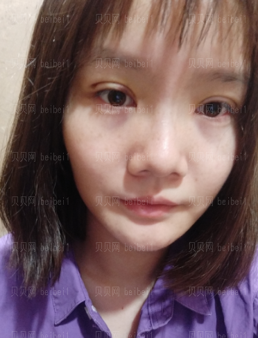 深圳阳光整形美容医院邹进进双眼皮+开眼角介绍片较新分享——自从有了双眼皮之后,随随便便撸个妆都感觉自己美爆了,现在的我比以前可自信多了