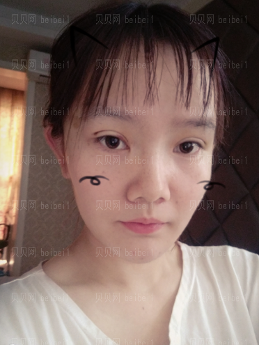 深圳阳光整形美容医院邹进进双眼皮+开眼角介绍片较新分享——自从有了双眼皮之后,随随便便撸个妆都感觉自己美爆了,现在的我比以前可自信多了