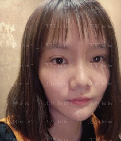 深圳阳光整形美容医院邹进进双眼皮+开眼角介绍片较新分享——自从有了双眼皮之后,随随便便撸个妆都感觉自己美爆了,现在的我比以前可自信多了