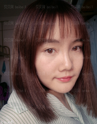 深圳阳光整形美容医院邹进进双眼皮+开眼角介绍片较新分享——自从有了双眼皮之后,随随便便撸个妆都感觉自己美爆了,现在的我比以前可自信多了