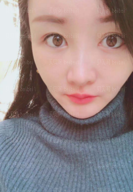 深圳阳光整形美容医院邹进进自体脂肪填充面部介绍片较新分享——整体恢复的还不错,就是眼周还需要一段时间