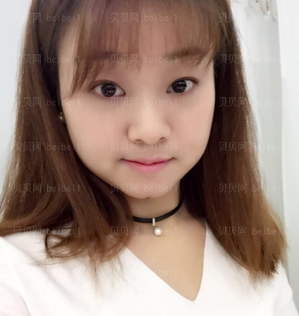深圳源美医疗美容门诊部吴晓玲上睑提肌介绍片较新分享——现在恢复的较为好呢,和之前真的差别很大啊
