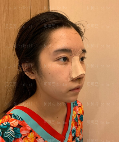 深圳源美医疗美容门诊部吴晓玲鼻部修复案例图片较新分享——整体果还是比较满意的，鼻子看起来很有立体感