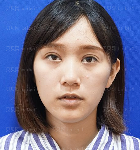 深圳源美医疗美容门诊部朱志祥眼部修复案例图片最新分享——眼睛现在恢复的很稳定，没有什么问题，弧度也挺自然的