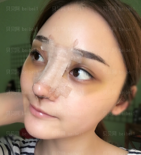 深圳源美医疗美容门诊部朱志祥鼻部修复案例图片最新分享——鼻子已经不肿了，恢复的很好，看起来很自然