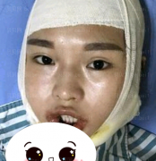 深圳源美医疗美容门诊部朱志祥瓜子脸整形案例图片最新分享——手术前和手术后的我真的是天壤之别