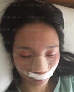 深圳臻瑞芝美医疗美容门诊部高焱膨体隆鼻+肋软骨垫鼻尖介绍片较新分享——现在的鼻子真的很nice，已经完全成为了自己的鼻子，就像天生的一样