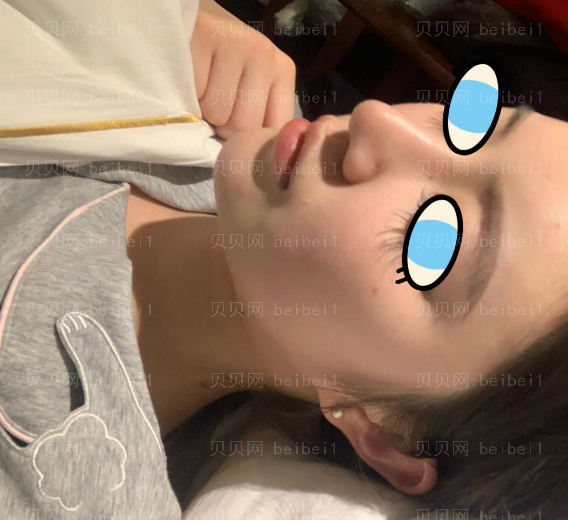 深圳臻瑞芝美医疗美容门诊部高焱肋软骨隆鼻案例图片最新分享——鼻子恢复的越来越好了，人也变得越来越自信了