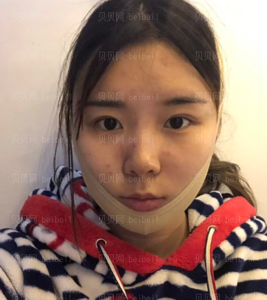 深圳臻瑞芝美医疗美容门诊部高焱下颌角磨骨案例图片最新分享——伤口已经基本上恢复了，虽然在嘴巴里面我自己看不到，但是还是可以感觉得到的