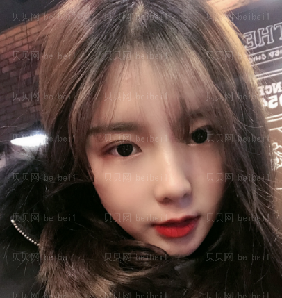 深圳臻瑞芝美医疗美容门诊部高焱下颌角磨骨介绍片较新分享——伤口已经基本上恢复了,虽然在嘴巴里面我自己看不到,但是还是可以感觉得到的