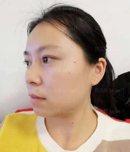 深圳臻瑞芝美医疗美容门诊部李远宏激光祛斑案例图片最新分享——我的皮肤现在已经恢复的越来越好了呢，而且之前的肤色不均、毛孔粗大等情况也都改