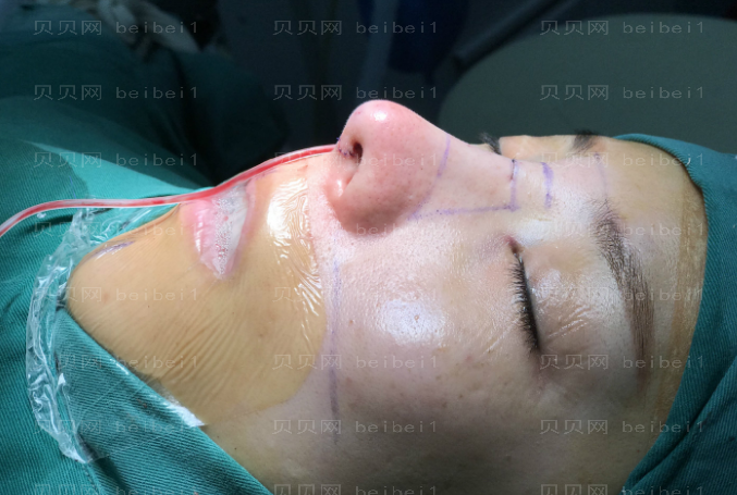 深圳臻瑞芝美医疗美容门诊部慕昕肋软骨隆鼻案例图片最新分享——鼻子已经恢复的比较自然了，感觉越来越好看了呢