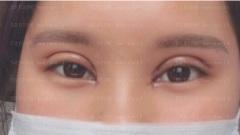 深圳臻瑞芝美医疗美容门诊部慕昕双眼皮案例图片最新分享——恢复到现在，眼睛看起来真的是越来越好看了