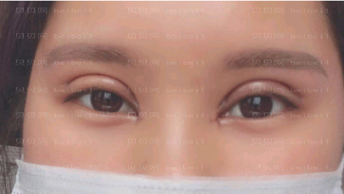 深圳臻瑞芝美医疗美容门诊部慕昕双眼皮案例图片较新分享——恢复到现在，眼睛看起来真的是越来越好看了