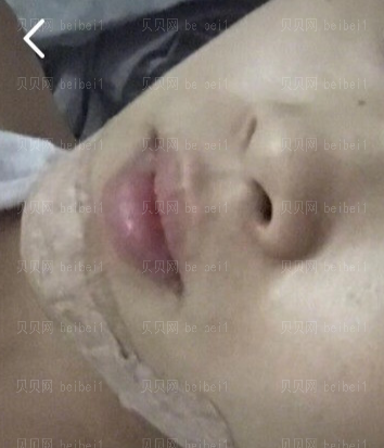 深圳臻瑞芝美医疗美容门诊部潘铁军假体垫下巴案例图片最新分享——下巴恢复的更加自然了，消肿已经消得差不多了