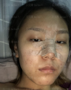 深圳臻瑞芝美医疗美容门诊部潘铁军假体隆鼻+垫鼻基底介绍片较新分享——感觉做了鼻子之后对自己的生活改变真的很大，稍微打扮打扮就可以出门逛街