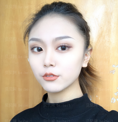 深圳臻瑞芝美医疗美容门诊部潘铁军假体隆鼻+垫鼻基底介绍片较新分享——感觉做了鼻子之后对自己的生活改变真的很大,稍微打扮打扮就可以出门逛街
