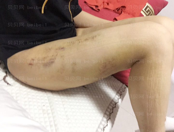 深圳臻瑞芝美医疗美容门诊部潘铁军全身吸脂案例图片较新分享——腿上的淤青已经差不多消完了，肿胀也基本都没有了