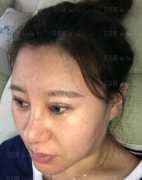 深圳臻瑞芝美医疗美容门诊部 张秀丽医生 点阵激光祛痘介绍分享