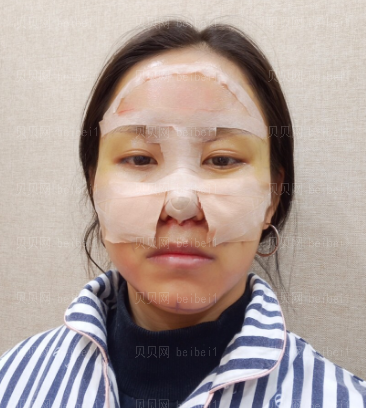 广州韩妃医学美容医院 曾繁茂医生 自体脂肪全脸填充案例分享