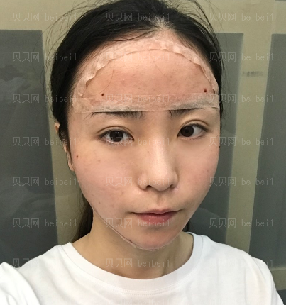 广州韩妃医学美容医院 曾繁茂医生 自体脂肪面部填充案例分享