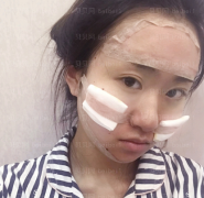 广州韩妃医学美容医院 李光琴医生 自体脂肪面部填充案例分享