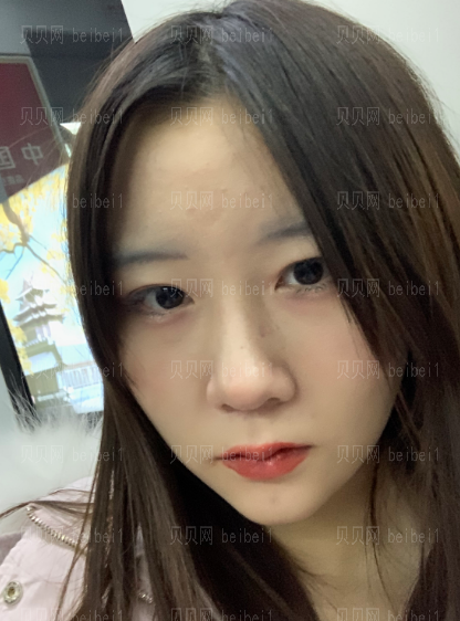 广州韩妃医学美容医院 刘永波医生 假体垫下巴介绍分享