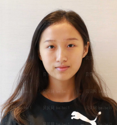 广州韩妃医学美容医院 牟北平医生 假体隆鼻介绍分享