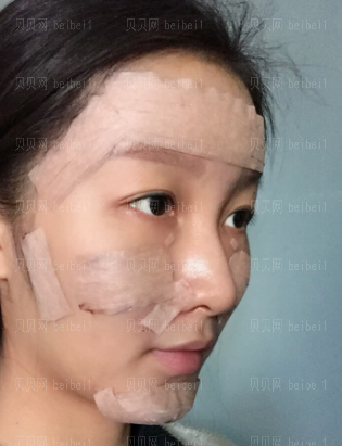 广州韩妃医学美容医院 牟北平医生 自体脂肪面部填充介绍分享
