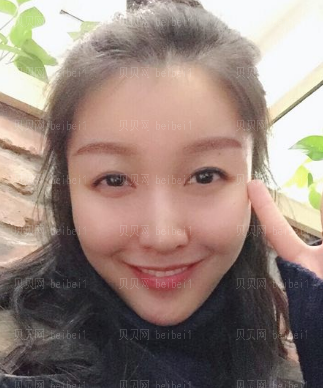 广州韩妃医学美容医院 牟北平医生 自体脂肪面部填充介绍分享