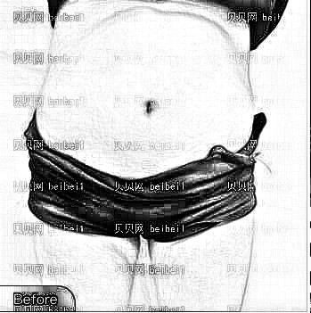 成都军大_孙延辉医生_腰腹吸脂_术后介绍分享！