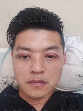 广州韩妃医学美容医院 王媛医生 双眼皮介绍分享