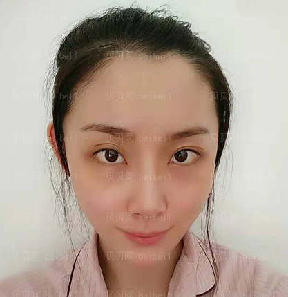 广州韩妃医学美容医院 王媛医生 去眼袋介绍分享