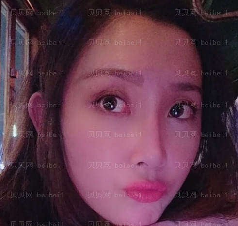 广州韩妃医学美容医院 王媛医生 去眼袋介绍分享