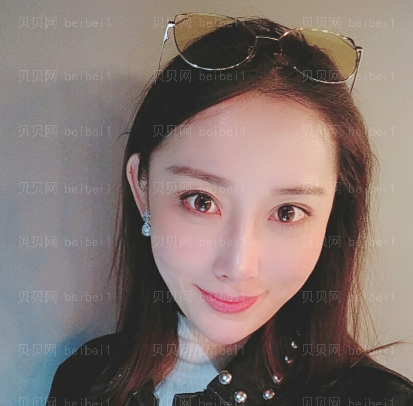 广州韩妃医学美容医院 王媛医生 去眼袋介绍分享