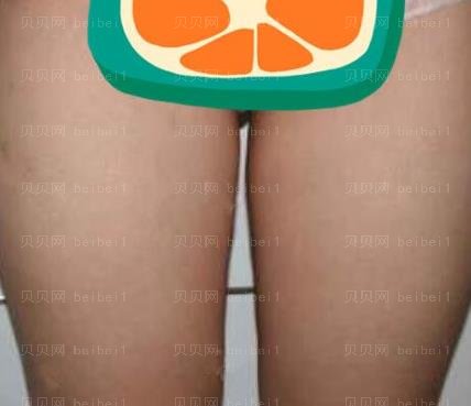 广州市荔湾区人民医院整形美容科,常辉彦,大腿环吸介绍