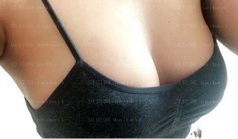 广州市荔湾区人民医院整形美容科,常辉彦,丰胸介绍,让我觉得整个人很轻松
