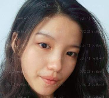广州市荔湾区人民医院整形美容科,常辉彦,双眼皮介绍,一双漂亮的眼睛晴很为颜值加分