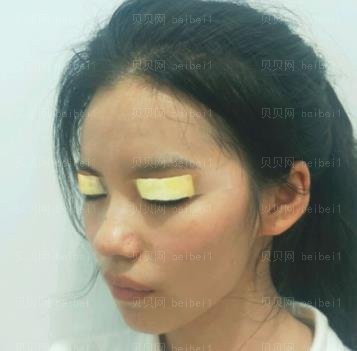 广州市荔湾区人民医院整形美容科,常辉彦,双眼皮介绍,一双漂亮的眼睛晴很为颜值加分